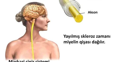 Dağılmış skleroz CAVANLAR XƏSTƏLİYİ