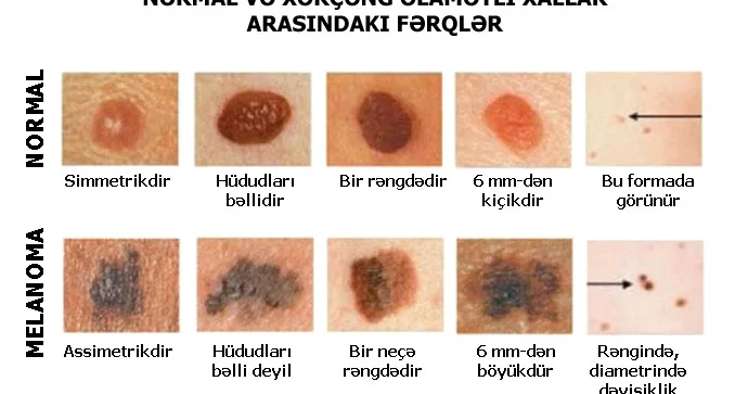 Bədəndəki xalların xərçəng əlaməti olduğunu necə təyin etmək olar?
