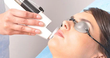 Lazer epilyasiyası nədir?