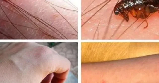 Birə dişləməsindən özümüzü NECƏ QORUYAQ? VACİB MƏQAMLAR