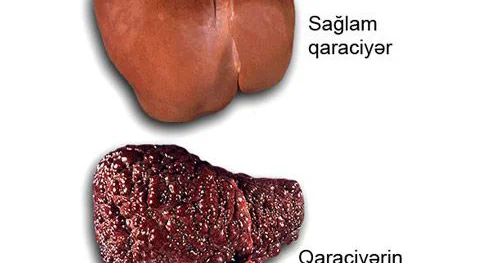 Xəstə qaraciyərin SOS siqnalları