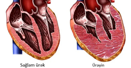 Ürəyin böyüməsi təhlükəli simptom