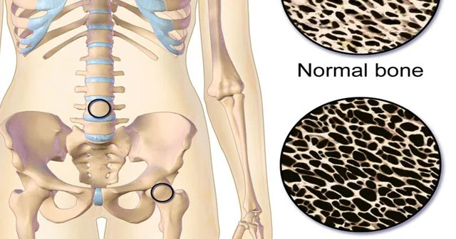 Sümük kütləsinin azalması OSTEOPOROZ. Səbəblər, simptomlar, müalicə
