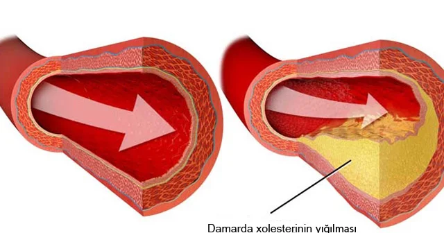 Yüksək xolesterinin 7 simptomu