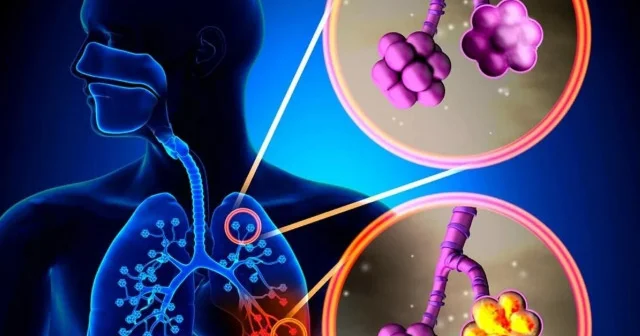 Koronavirusdan ölümün əsas səbəbi PNEVMONİYA. Simptomlar, müalicə