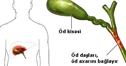 Xolesistit öd kisəsi iltihabı