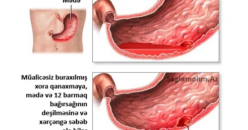 Xora xəstəliyinin ağırlaşmaları xoranın deşilməsi və daxili qanaxma