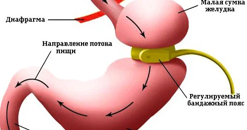 ЛЕЧЕНИЕ ОЖИРЕНИЯ. САМЫЙ ЭФФЕКТИВНЫЙ СПОСОБ