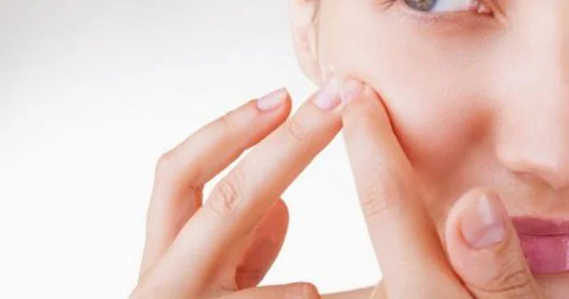 Sızanaqları sıxmayın, yoxsa... Dermatoloqdan MƏSLƏHƏTLƏR