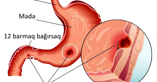 İçdiyiniz dərmanları mədəni necə korlayır Əlamətlər