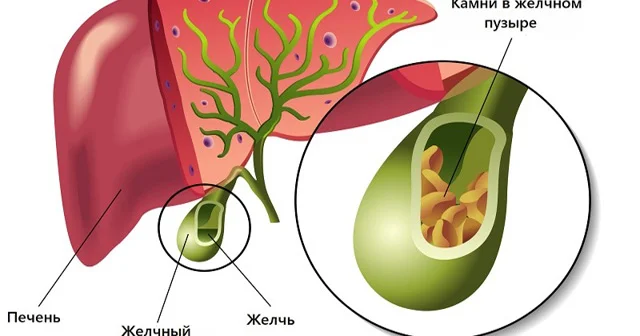 Qaraciyər və öd daşı xəstələrinin PƏHRİZİ
