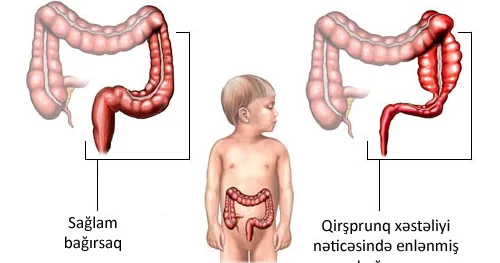 Körpələrdə qəbizliyin təhlükəsi Qirşprunq xəstəliyi
