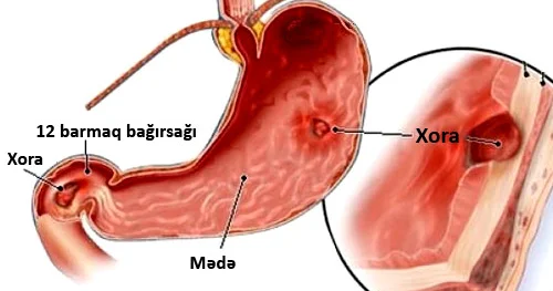 Mədəsi xəstə olanlar belə qidalanmalıdır. Vacib QAYDALAR