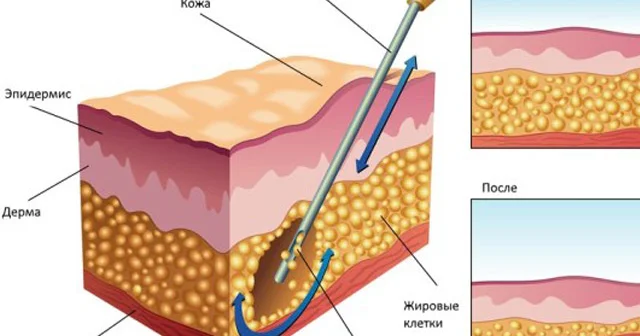 Liposaksiya əməliyyatında ölüm halları niyə artır? Plastik cərrah səbəbi açıqladı
