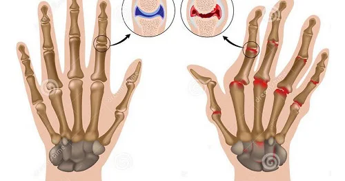 Revmatoid artrit ağır oynaq xəstəliyi FOTO