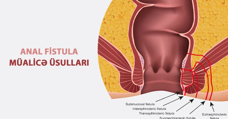 Fistula nə qədər ciddi problemdir? Cərrah açıqlayır
