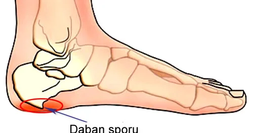 Dabanda ağrıların səbəbi daban şporları
