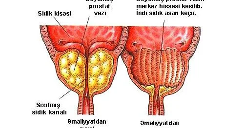 Prostat vəzinin adenoması xoşxassəli şişdir