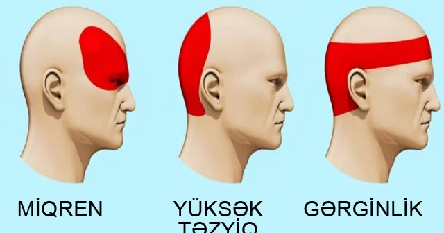 Başınız ağrıyırsa, dərman atmayın, bu çaylardan birini için