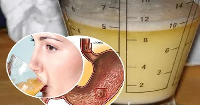 QASTRİTin kartof şirəsi ilə müalicəsi