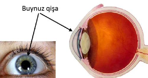 Keratit gözün buynuz qişasının iltihabı