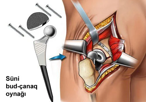 Koksartroz budçanaq oynağı xəstəliyi