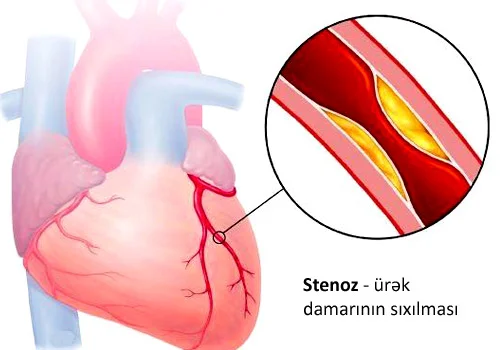 Ürək nahiyəsində ağrıların səbəbləri