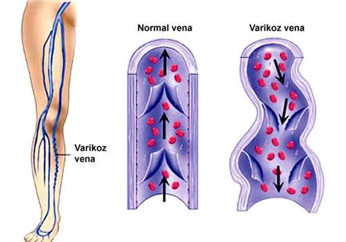 Varikoz xəstəliyi nədir?