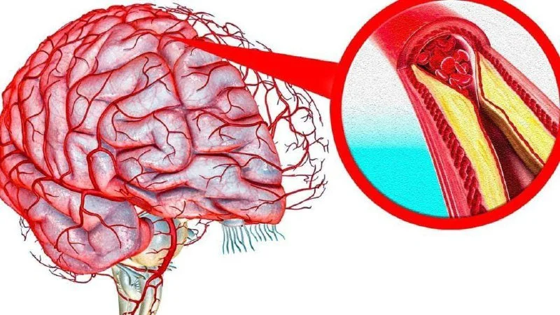 Qan damarları elastikləşir, başgicəllənmə yox olur Bu resepti SINAYIN!