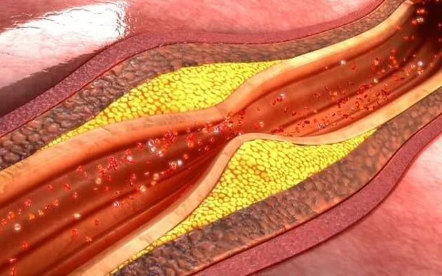 Arteriyaları məhv edən 5 QİDA