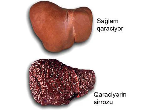 Xəstə qaraciyərin SOS siqnalları