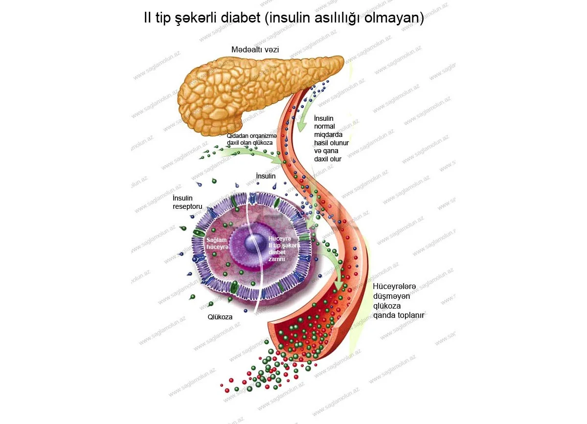 Şəkərli diabet