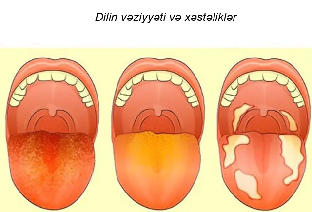 Dil niyə saralır? Səbəblər Foto