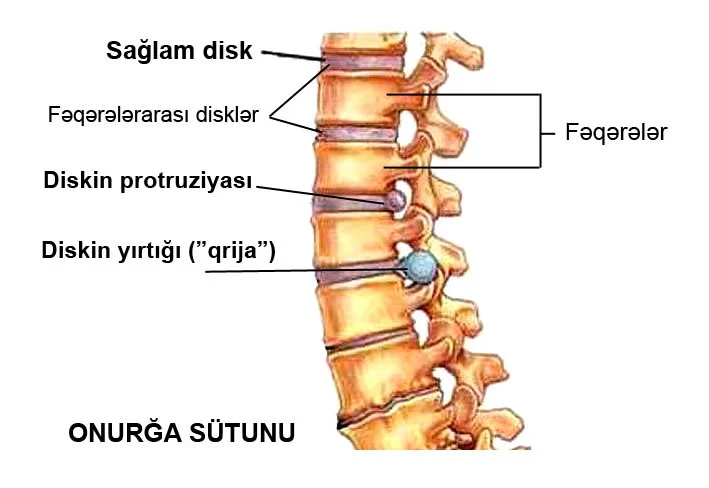 Osteoxondroz nədir?