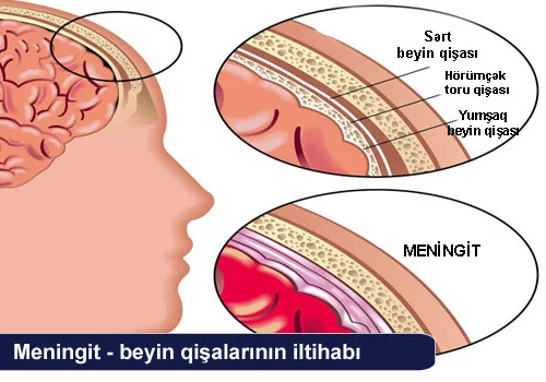 MENİNGİT. Səbəblər, simptomlar, müalicə