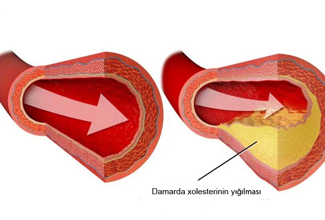 Yüksək xolesterinin 7 simptomu