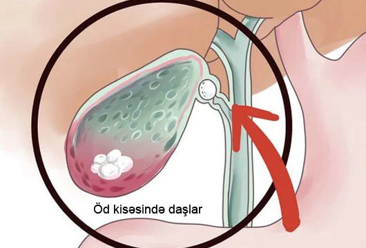 Öd daşı xəstəliyi. Kimlər risk qrupundadır?