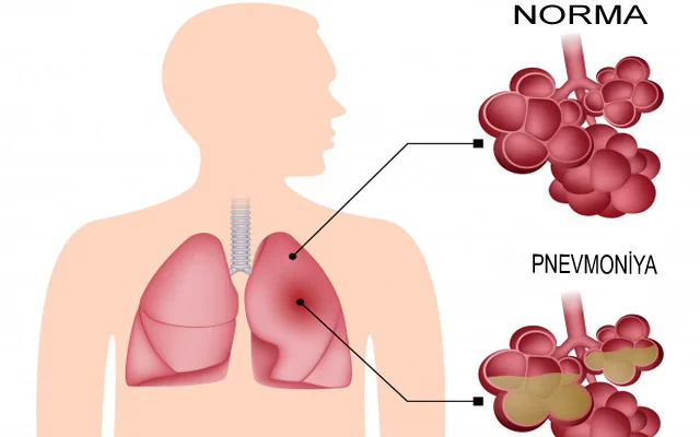 Pnevmoniyanın ən erkən 3 SİMPTOMU