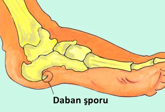 Daban şporlarının müalicəsi