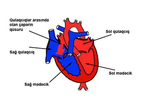 Anadangəlmə ürək qüsurları