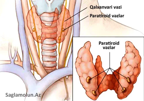 Kövrək sümüklər, böyrək daşları, qəbizlik. Bu hiperparatireoz ola bilər!