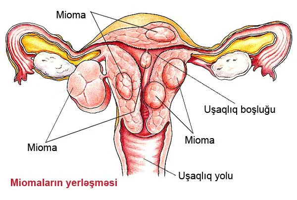 Uşaqlığın mioması Azərbaycanda çox yayılmış xəstəlikdir