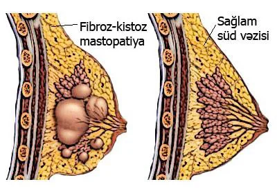 Mastopatiya və onun səbəbləri