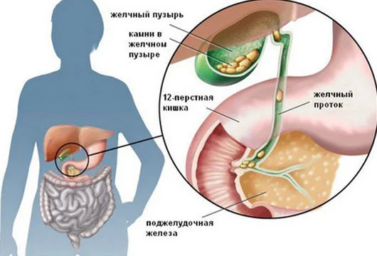 Öd kisəsində daşlar BU SƏBƏBLƏRƏ GÖRƏ əmələ gəlir