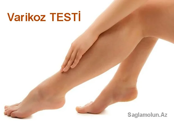 Sizdə varikoz xəstəliyi inkişaf edə bilər? TEST