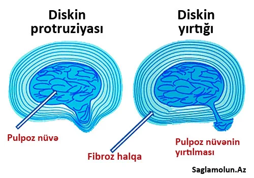 Fəqərəarası diskin protruziyası. Diaqnostika və müalicə