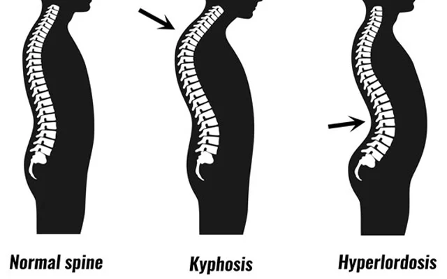 Kifoz nədir? Onurğa əyriliyinin FƏSADLARI və MÜALİCƏSİ