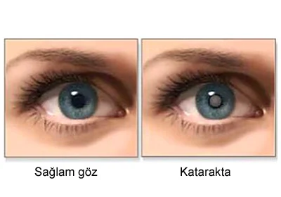 Katarakta yayılmış göz xəstəliyi. SƏBƏBLƏRİ