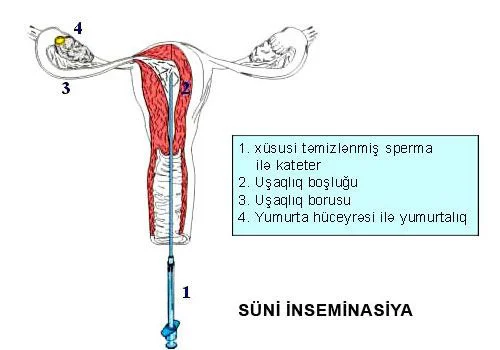 Uşaqlıqdaxili inseminasiya