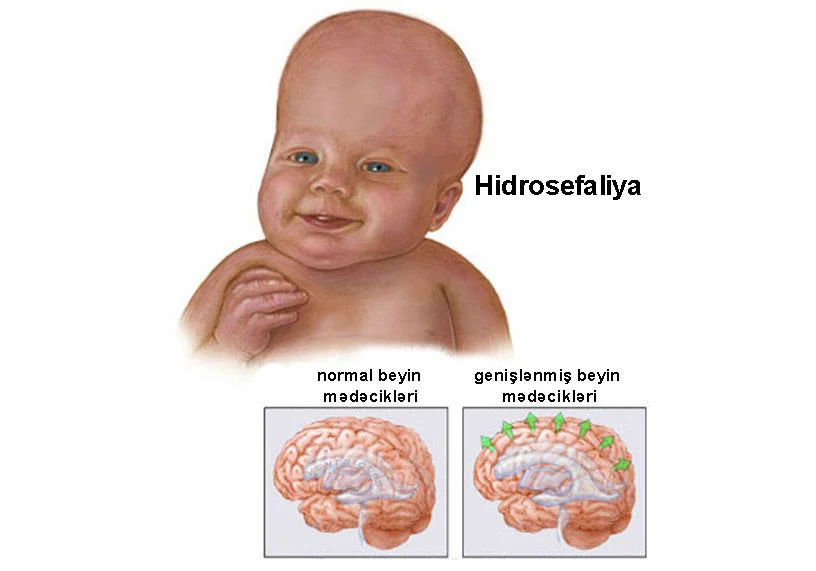 Körpə uşaqlarda hidrosefaliya xəstəliyi